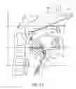 Fig. 75 - Tissue anchoring system for percutaneous glossoplasty