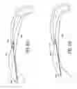 Fig. 76 - Tissue anchoring system for percutaneous glossoplasty