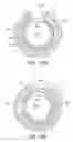 Fig. 79 - Tissue anchoring system for percutaneous glossoplasty