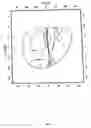 Fig. 10 - Method for determination of an ophthalmic lens using an astigmatism prescription for far sight and for near sight