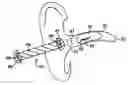 Fig. 01 - Remote magnetic activation of hearing devices