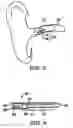 Fig. 03 - Remote magnetic activation of hearing devices