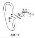 Fig. 10 - Remote magnetic activation of hearing devices
