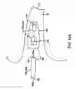 Fig. 11 - Remote magnetic activation of hearing devices