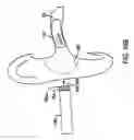 Fig. 18 - Remote magnetic activation of hearing devices