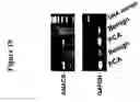 Fig. 111 - Expression profile of prostate cancer