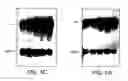 Fig. 03 - Modulation of hedgehog-mediated signaling pathway