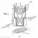 Fig. 02 - Anastomosis device with separable section