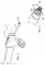 Fig. 04 - Anastomosis device with separable section