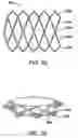 Fig. 22 - Anastomosis device with separable section