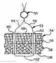 Fig. 01 - Method and apparatus for securing a suture