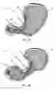 Fig. 06 - Gastrointestinal volume manipulation