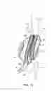 Fig. 22 - Graft systems having filling structures supported by scaffolds and methods for their use