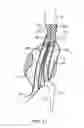 Fig. 23 - Graft systems having filling structures supported by scaffolds and methods for their use