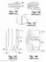 Fig. 02 - Method and apparatus for total disc replacements with oblique keels