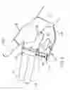 Fig. 07 - Partial hand prosthesis