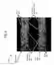 Fig. 07 - Method and apparatus for virtual subtraction of stool from registration and shape based analysis of prone and supine scans of the colon