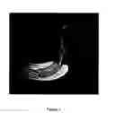 Fig. 06 - Methods for treating a stricture with a botulinum toxin