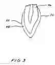 Fig. 04 - Dental appliance