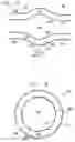 Fig. 16 - Fully-implantable cardiac recovery system