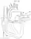 Fig. 23 - Fully-implantable cardiac recovery system