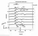 Fig. 05 - Method for automated analysis of submaximal F-waves