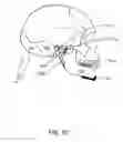 Fig. 08 - System and method for temporo-mandibular joint decompression during cervical traction