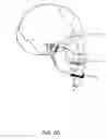 Fig. 09 - Inflatable spiral traction device, system, and method