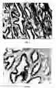Fig. 10 - Methods and devices for delivering therapeutic agents into the prostate gland