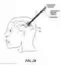 Fig. 07 - Cooled laser fiber for improved thermal therapy