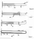 Fig. 05 - Electrosurgical device with discontinuous flow density