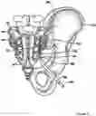 Fig. 07 - Electrosurgical device with discontinuous flow density