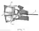 Fig. 08 - Expandable intervertebral disc dilating cannula