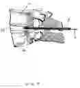 Fig. 09 - Expandable intervertebral disc dilating cannula