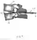 Fig. 10 - Expandable intervertebral disc dilating cannula