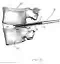 Fig. 11 - Expandable intervertebral disc dilating cannula