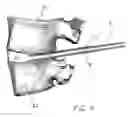 Fig. 15 - Expandable intervertebral disc dilating cannula