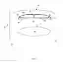 Fig. 03 - Device and method of weight control via indirect abdominal cavity volume reduction