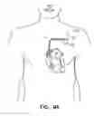 Fig. 07 - System to provide myocardial and neural stimulation