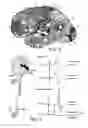 Fig. 06 - Method and system for cortical stimulation to provide adjunct (ADD-ON) therapy for stroke, tinnitus and other medical disorders using implantable and external components