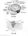 Fig. 07 - Method and system for cortical stimulation to provide adjunct (ADD-ON) therapy for stroke, tinnitus and other medical disorders using implantable and external components
