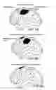 Fig. 08 - Method and system for cortical stimulation to provide adjunct (ADD-ON) therapy for stroke, tinnitus and other medical disorders using implantable and external components