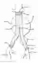 Fig. 01 - Methods and Devices for Contributing to Improved Stent Graft Fixation and/or Seal