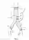 Fig. 03 - Methods and Devices for Contributing to Improved Stent Graft Fixation and/or Seal