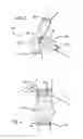 Fig. 04 - Methods and Devices for Contributing to Improved Stent Graft Fixation and/or Seal