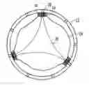 Fig. 01 - Heart valve and method for insertion of the heart valve into a bodily vessel