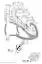 Fig. 07 - Heart valve and method for insertion of the heart valve into a bodily vessel