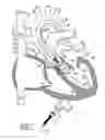 Fig. 08 - Heart valve and method for insertion of the heart valve into a bodily vessel