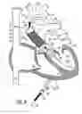 Fig. 09 - Heart valve and method for insertion of the heart valve into a bodily vessel