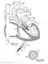 Fig. 11 - Heart valve and method for insertion of the heart valve into a bodily vessel